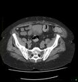 Acute renal failure post IV contrast injection- CT findings (Radiopaedia 47815-52557 Axial non-contrast 63).jpg