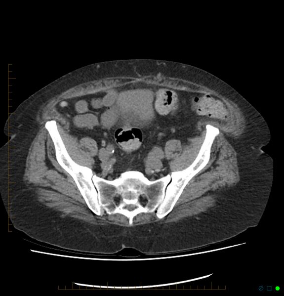 File:Acute renal failure post IV contrast injection- CT findings (Radiopaedia 47815-52557 Axial non-contrast 63).jpg