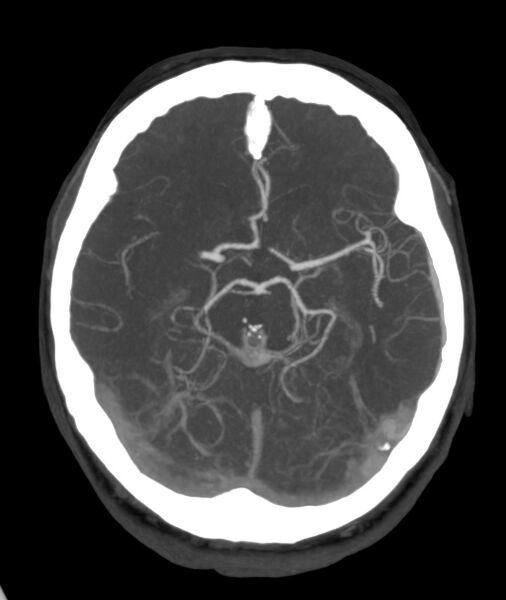 File:Acute right MCA M1 occlusion (Radiopaedia 62268-70454 Axial Phase 1 17).jpg