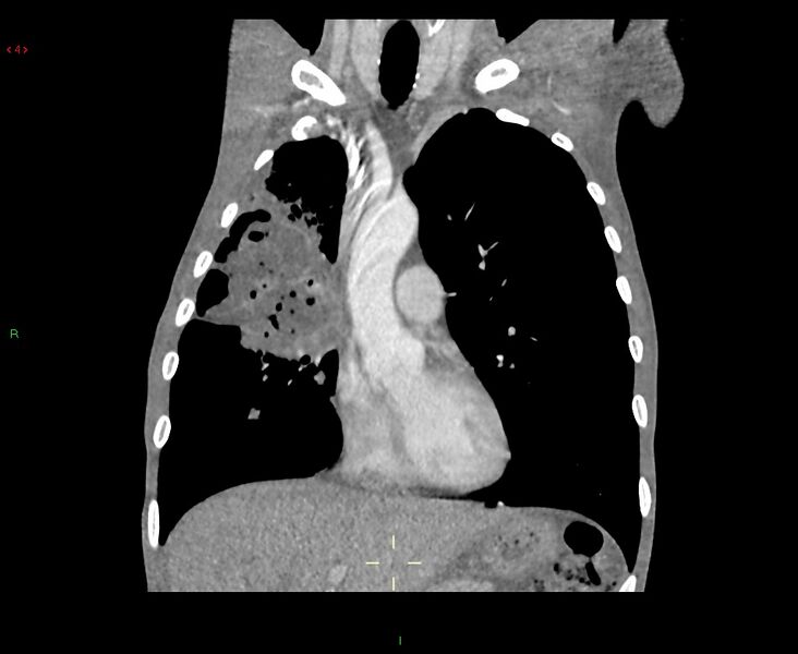 File:Acute right lung abscess (Radiopaedia 34806-36258 Coronal C+ arterial phase 36).jpg