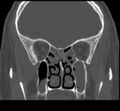 Acute sinusitis (Radiopaedia 23161-23215 Coronal bone window 40).jpg