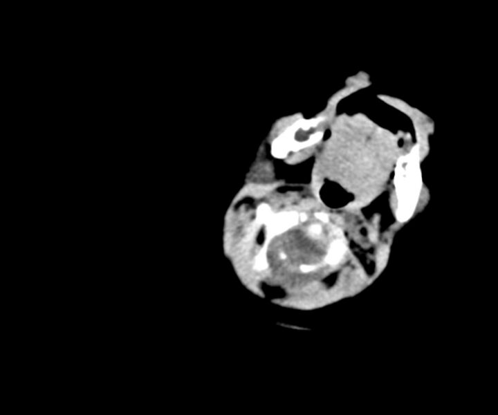 File:Acute ventriculitis (Radiopaedia 57502-64459 Axial non-contrast 2).jpg