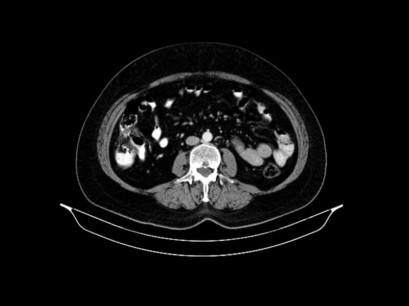 File:Adenocarcinoma of pancreas with hepatic metastasis (Radiopaedia 64332-73122 Axial C+ portal venous phase 57).jpg