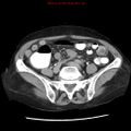 Adenocarcinoma of the colon (Radiopaedia 8191-9039 Axial renal excretory phase 37).jpg