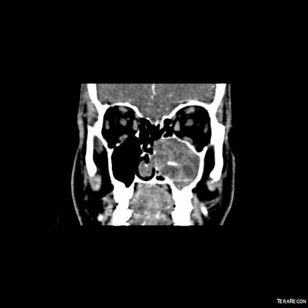 File:Adenoid cystic carcinoma involving paranasal sinus (Radiopaedia 16580-16283 Coronal C+ arterial phase 5).jpeg