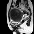 Adenomyoma of the uterus (huge) (Radiopaedia 9870-10438 Sagittal T2 16).jpg
