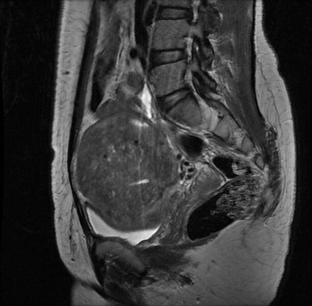 File:Adenomyosis on MRI (Radiopaedia 29328-29780 Sagittal T2 6).jpg