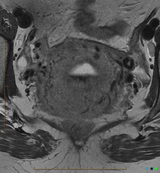File:Adenomyosis uterus with hematometra (Radiopaedia 45779-50011 Axial T2 19).jpg
