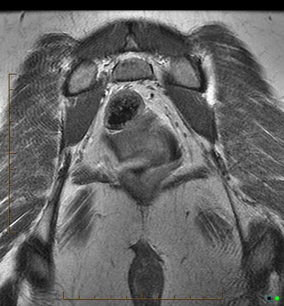 File:Adenomyosis uterus with hematometra (Radiopaedia 45779-50011 Coronal T2 24).jpg