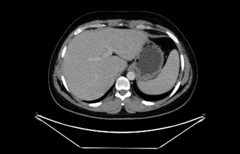 File:Adrenocortical carcinoma (Radiopaedia 80134-93438 Axial C+ portal venous phase 26).jpg