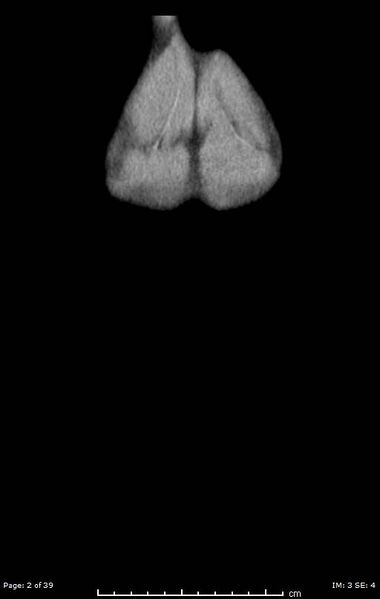 File:Agenesis of the gallbladder (Radiopaedia 55454-61905 A 2).jpg