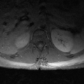 Aggressive vertebral hemangioma (Radiopaedia 39937-42404 Axial T1 C+ fat sat 5).png