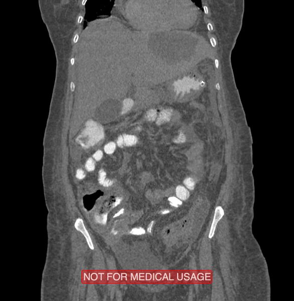 File:Amoebic enterocolitis with liver abscess (Radiopaedia 35100-36609 B 60).jpg