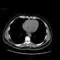 Ampullary carcinoma (Radiopaedia 56396-63056 Axial non-contrast 3).jpg