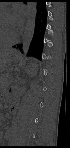 File:Aneurysmal bone cyst T11 (Radiopaedia 29294-29721 Sagittal bone window 20).jpg