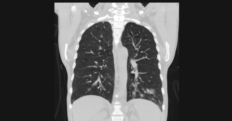 File:Angioinvasive aspergellosis (Radiopaedia 66995-76315 Coronal lung window 41).jpg