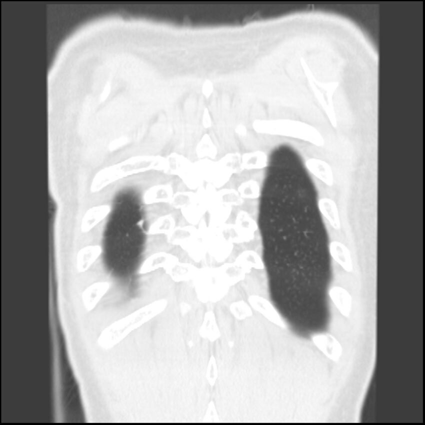 Angioinvasive aspergillosis (Radiopaedia 43957-47466 Coronal lung window 5).jpg