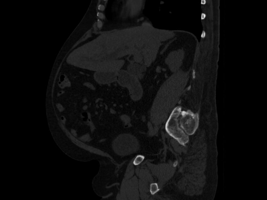 Ankylosing spondylitis (Radiopaedia 44609-48357 Sagittal bone window 38).jpg