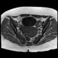 Ano-vaginal fistula (Radiopaedia 29765-30284 Axial T1 21).jpg