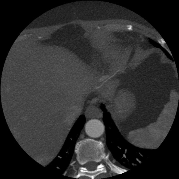 File:Anomalous origin of left circumflex artery from right coronary sinus (Radiopaedia 72563-83117 A 2).jpg