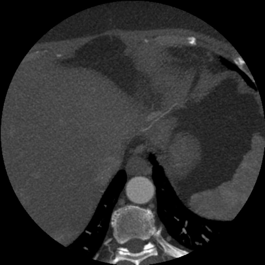 Anomalous origin of left circumflex artery from right coronary sinus (Radiopaedia 72563-83117 A 2).jpg