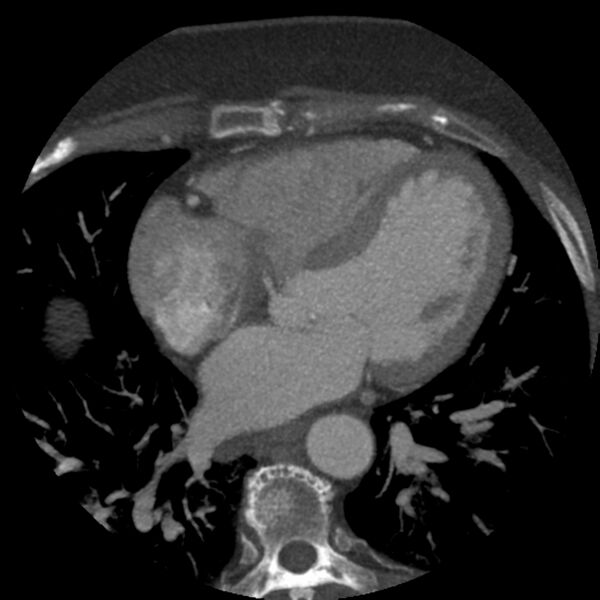 File:Anomalous origin of left circumflex artery from right coronary sinus (Radiopaedia 72563-83117 A 29).jpg