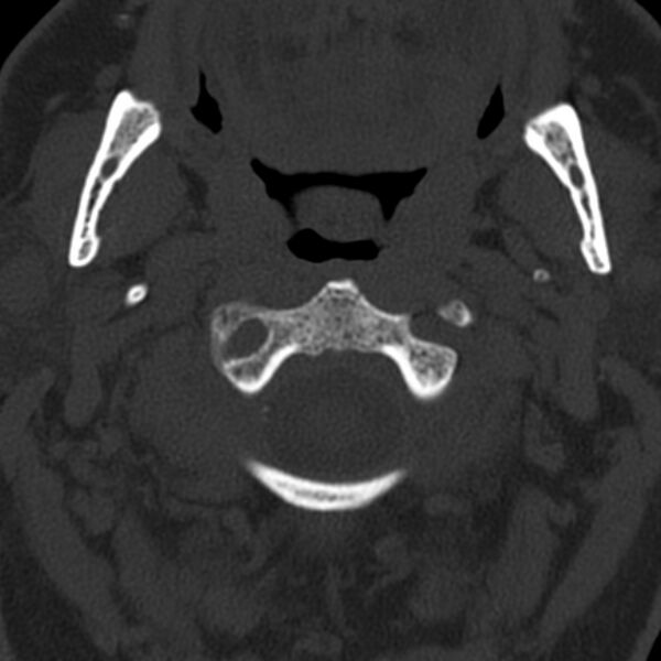 File:Anterior cervical postdiscectomy arthrodesis (Radiopaedia 32678-33646 Axial bone window 18).jpg