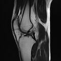 Anterior cruciate ligament full thickness tear (Radiopaedia 66268-75467 Sagittal T2 12).jpg