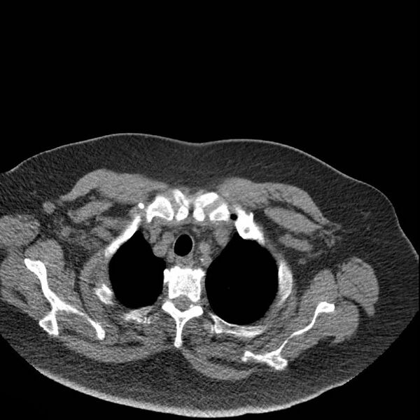 File:Aortic arch false aneurysm (Radiopaedia 14667-14587 Axial non-contrast 29).jpg