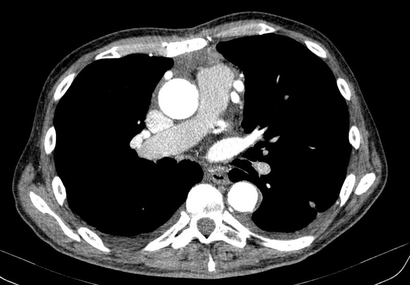 File:Aortic arch saccular aneurysm (Radiopaedia 19430-19457 B 21).jpg