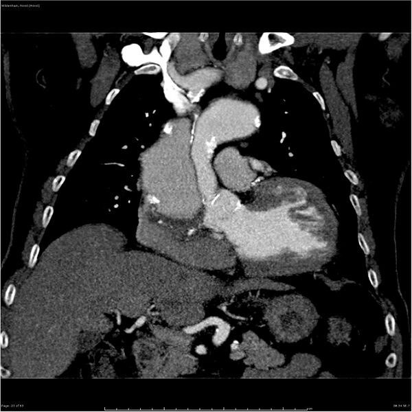 File:Aortic dissection - Stanford type A (Radiopaedia 26183-26315 A 21).jpg