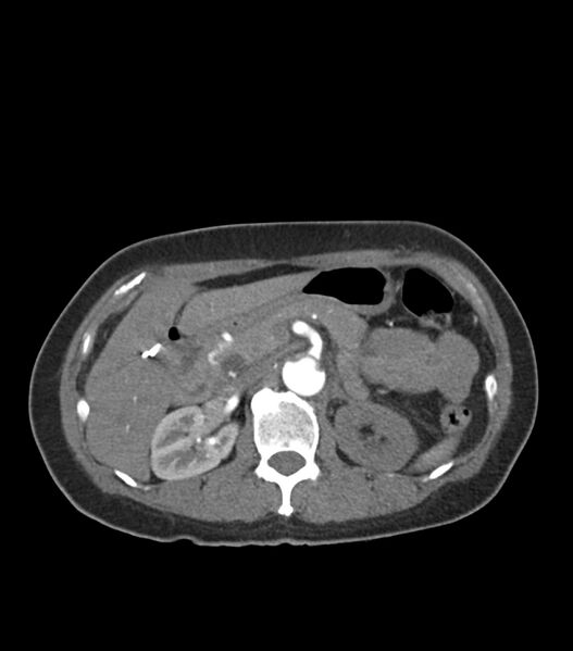 File:Aortic dissection with renal ischemia (Radiopaedia 76573-88338 A 65).jpg