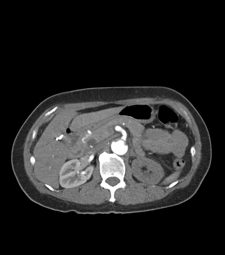 Aortic dissection with renal ischemia (Radiopaedia 76573-88338 A 65).jpg