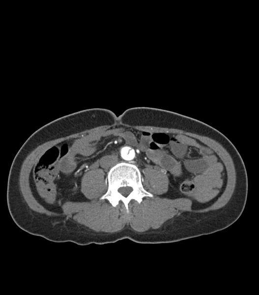 File:Aortic dissection with renal ischemia (Radiopaedia 76573-88338 A 83).jpg