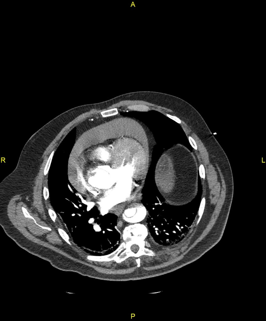 Aortic rupture (Radiopaedia 88822-105594 B 150).jpg