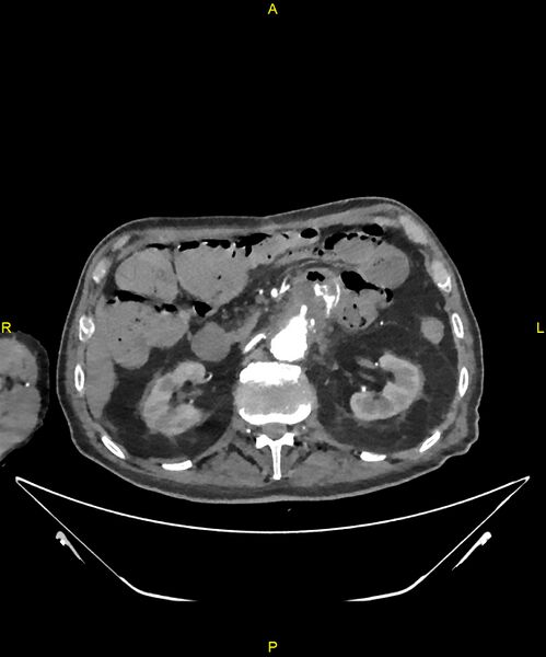 File:Aortoenteric fistula (Radiopaedia 84308-99603 B 121).jpg