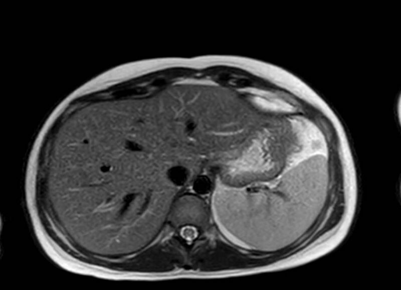 File:Appendicitis in gravida (MRI) (Radiopaedia 89433-106395 Axial T2 9).jpg