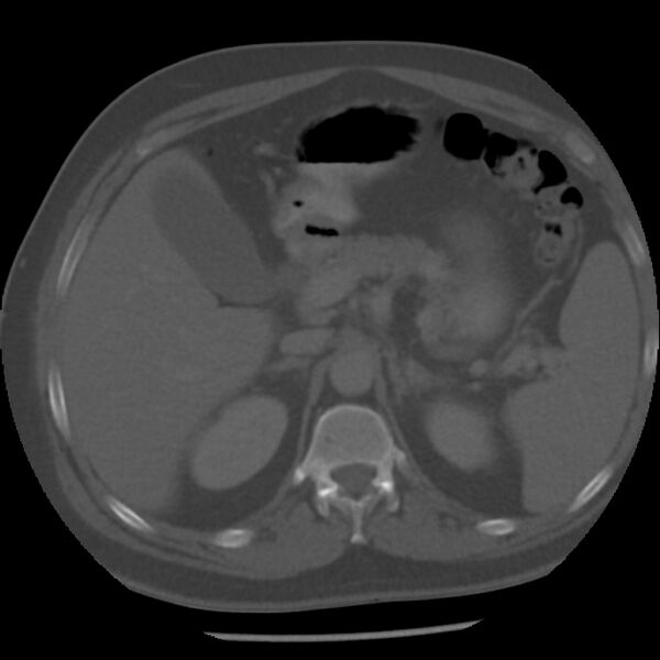 File:Appendicitis with perforation (Radiopaedia 35790-37342 Axial bone window 14).jpg