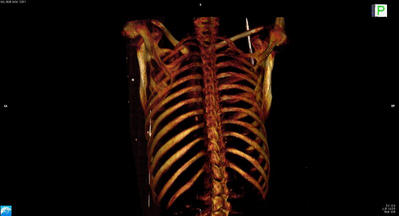 File:Arrow injury to the neck (Radiopaedia 75225-86323 3D bone 20).jpg