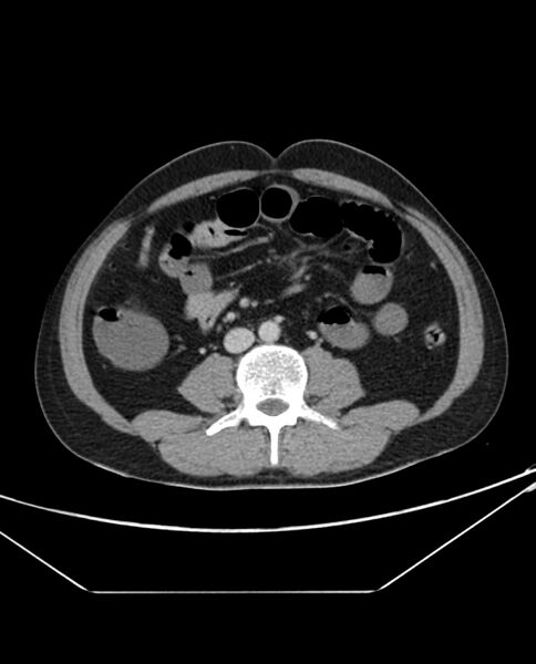 File:Arterial occlusive mesenteric ischemia (Radiopaedia 84641-100054 A 65).jpg