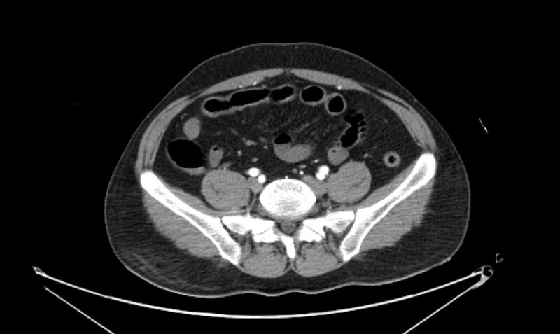 File:Arterial occlusive mesenteric ischemia (Radiopaedia 84641-100060 A 94).jpg