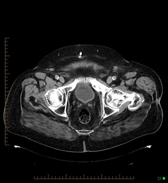 File:Artificial urethral sphincter (Radiopaedia 46937-51464 A 8).jpg