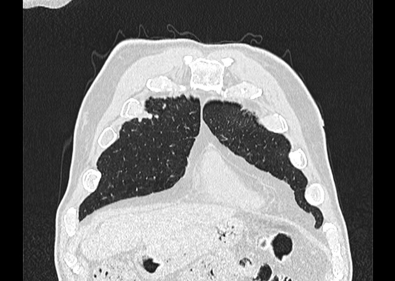 File:Asbestos pleural placques (Radiopaedia 57905-64872 Coronal lung window 29).jpg