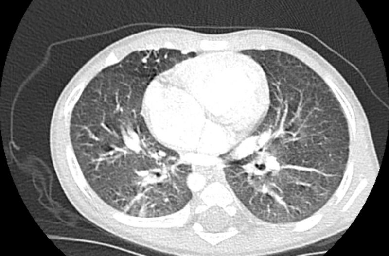 File:Asplenia syndrome (Radiopaedia 73083-83792 Axial lung window 40).jpg