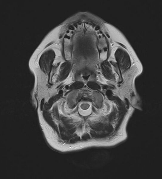 File:Asymmetric Fatty Marrow in the Petrous Apex (Radiopaedia 55572-62069 Axial T2 3).jpg