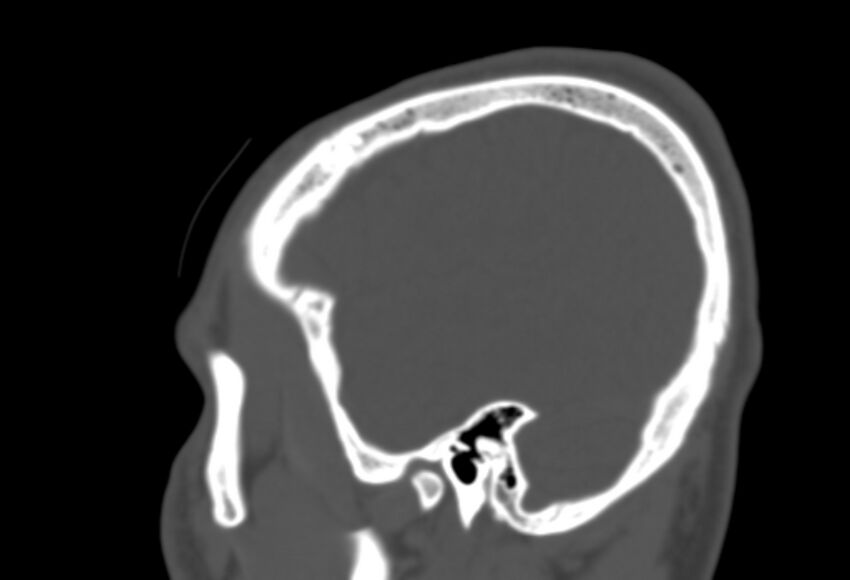 Asymptomatic occipital spur (Radiopaedia 87753-104201 Sagittal bone window 263).jpg