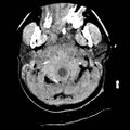Atlanto-occipital dislocation (Radiopaedia 44648-48412 Axial non-contrast 4).jpg
