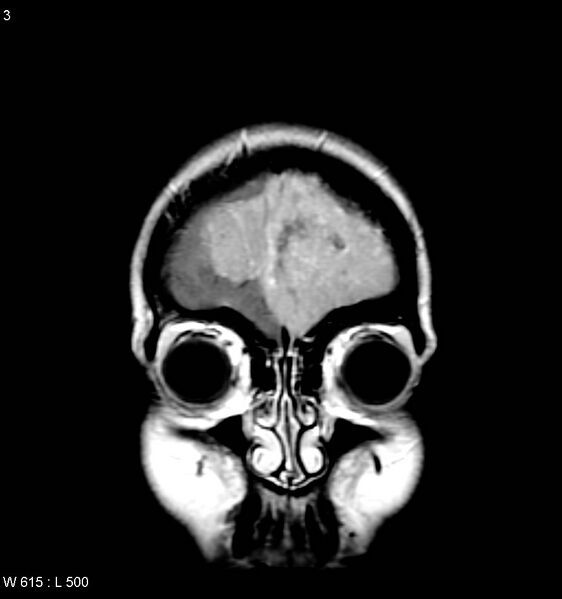 File:Atypical meningioma (WHO grade II) (Radiopaedia 7762-8586 Coronal T1 C+ 1).jpg