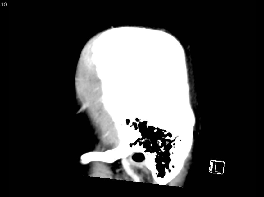 Atypical meningioma - intraosseous (Radiopaedia 64915-73867 F 9).jpg