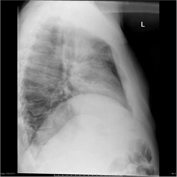 File:Atypical pneumonia - Q fever (Radiopaedia 21993-21988 Lateral 1).jpg